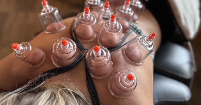 Therapeutic Cupping